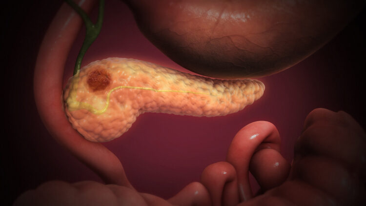 Daraxonrasib, farmaco per il possibile trattamento del PDAC? 2